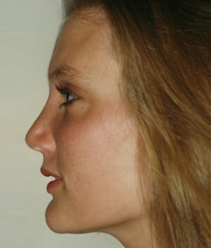 Rhinoplasty Before & After Image