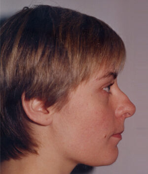 Rhinoplasty Before & After Image