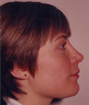 Rhinoplasty Before & After Image