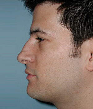 Rhinoplasty Before & After Image