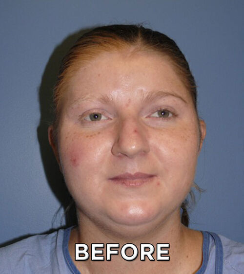 Rhinoplasty Before & After Image