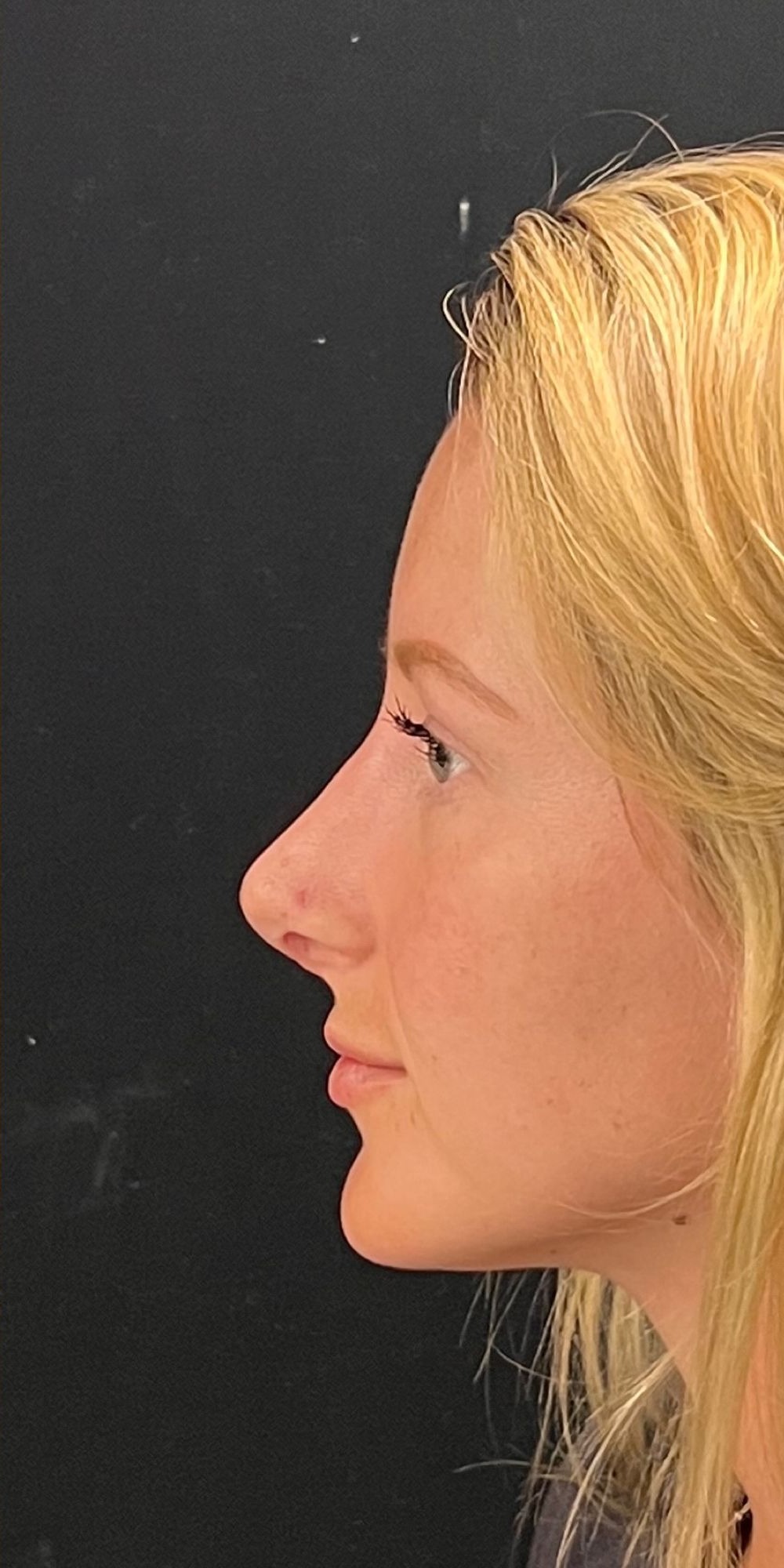 Rhinoplasty Before & After Image