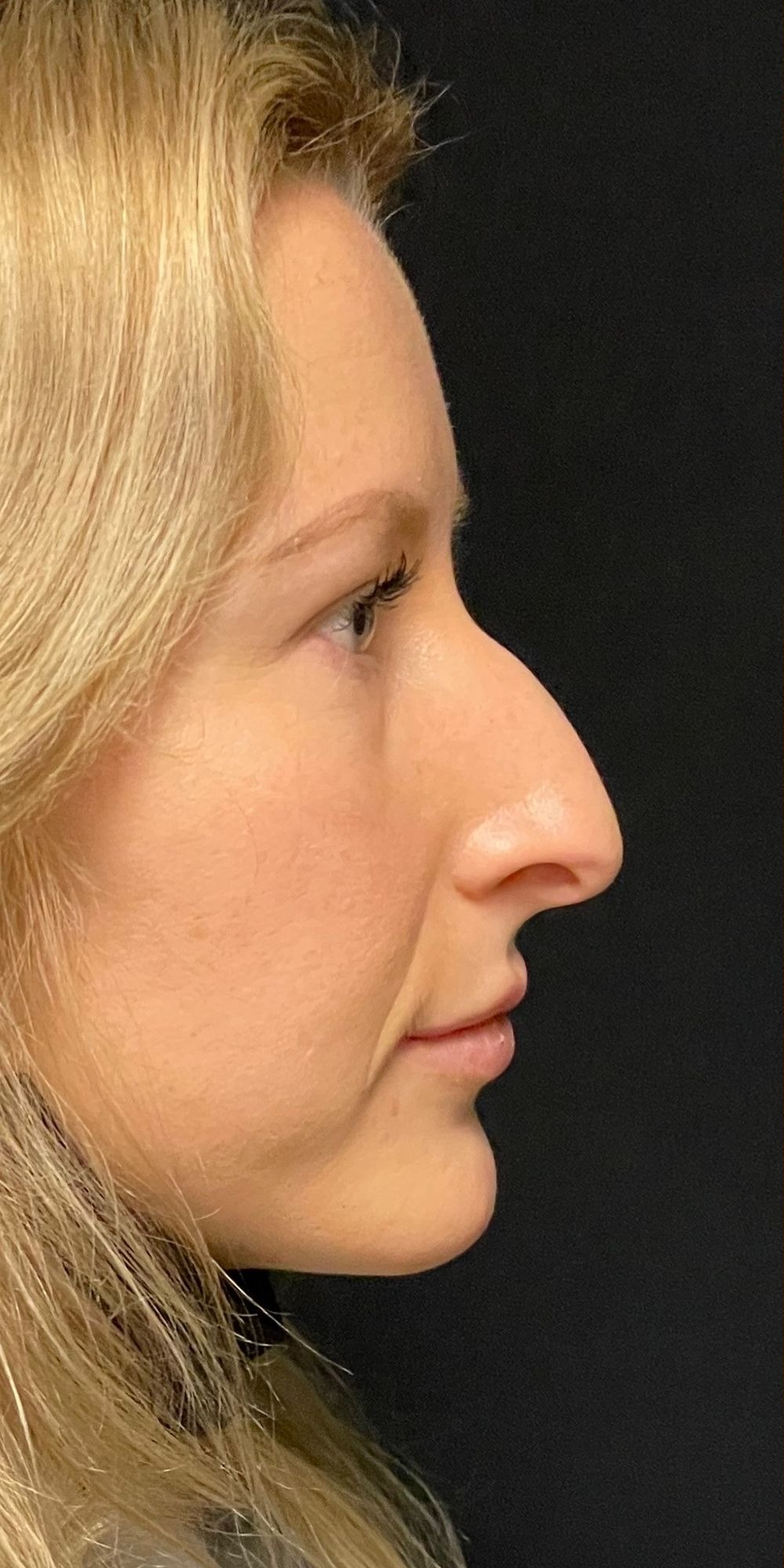 Rhinoplasty Before & After Image