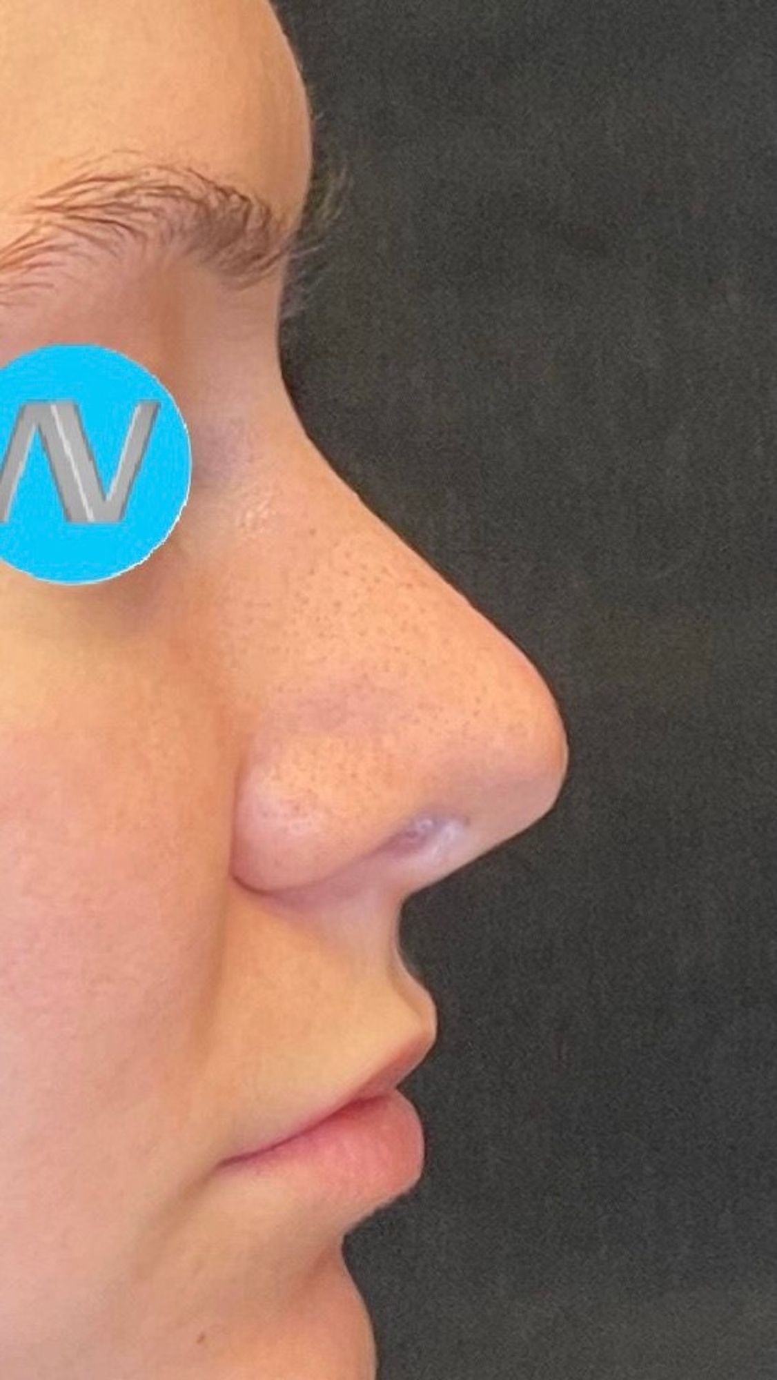 Rhinoplasty Before & After Image