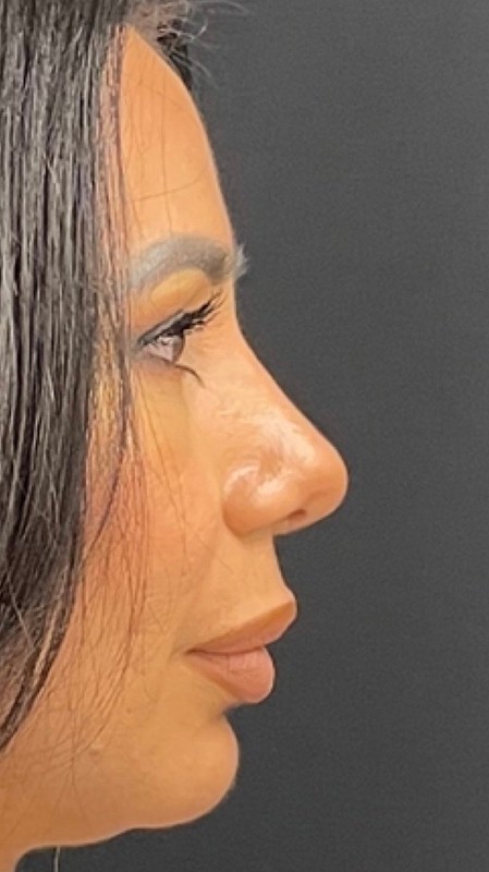 Rhinoplasty Before & After Image