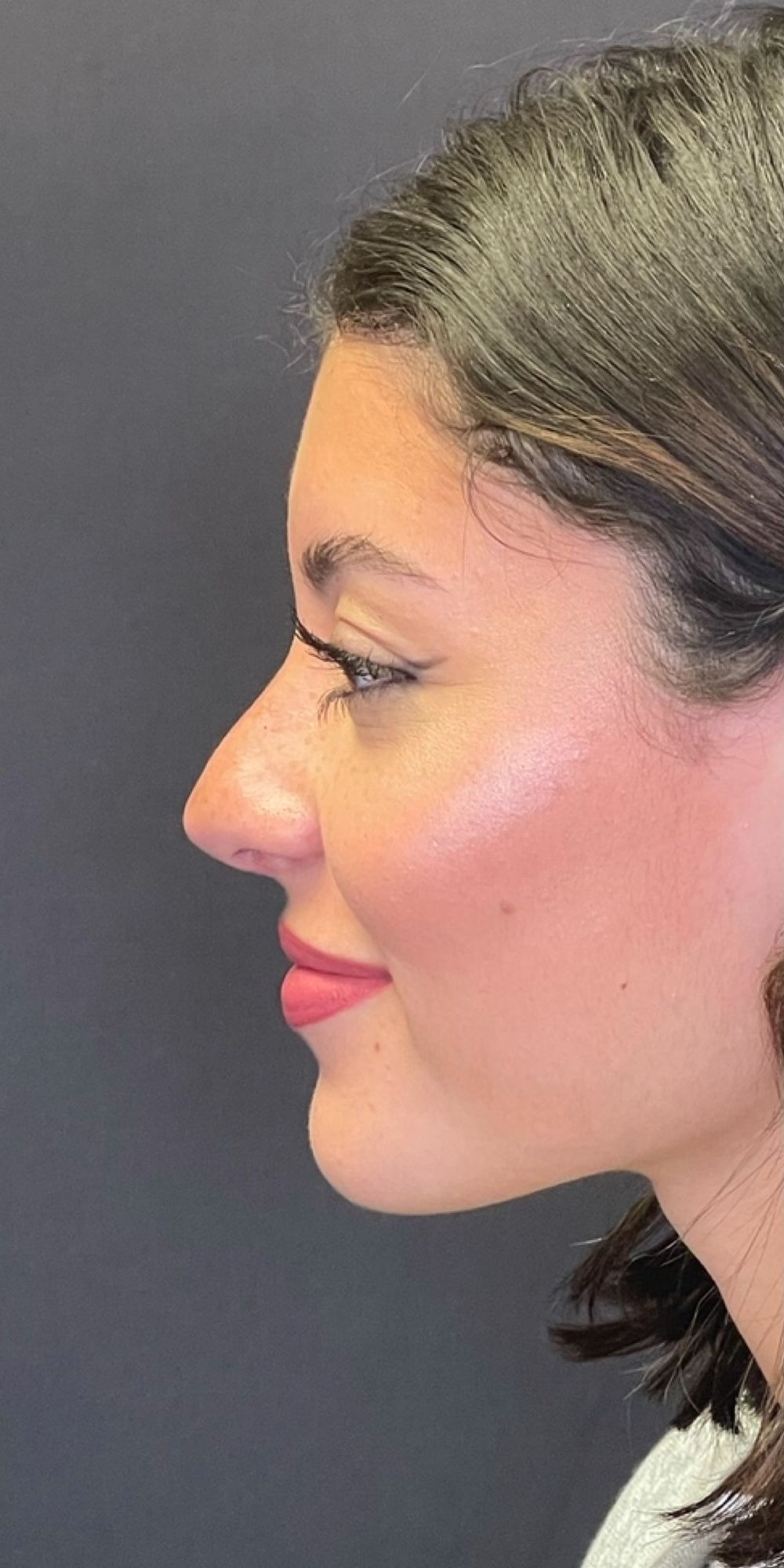 Rhinoplasty Before & After Image