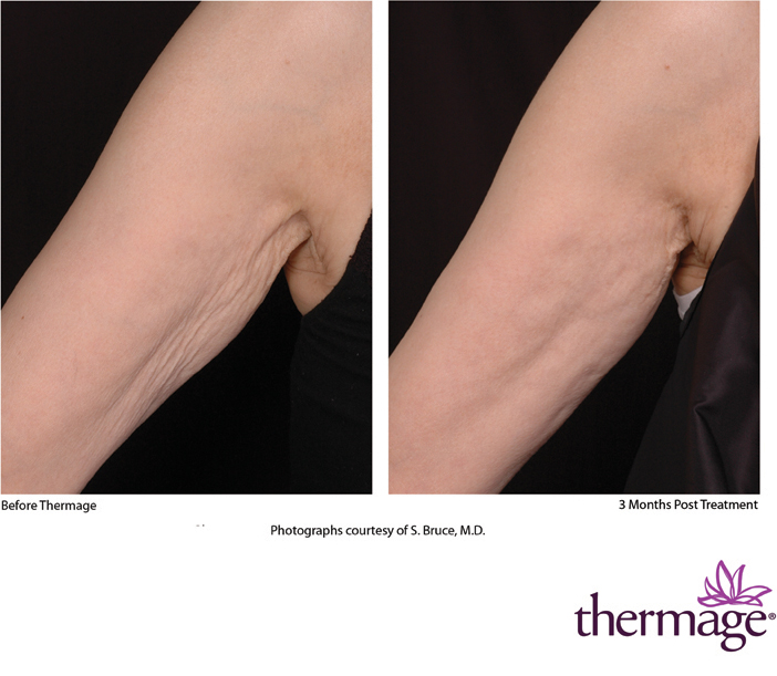 Thermage treatment on Arms Before and After