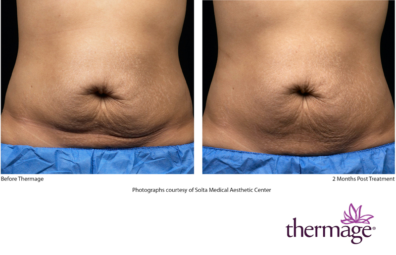 Thermage Treatment on Stomach Before and After