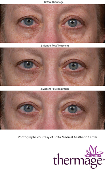 Thermage treatment on Eyes Before and After