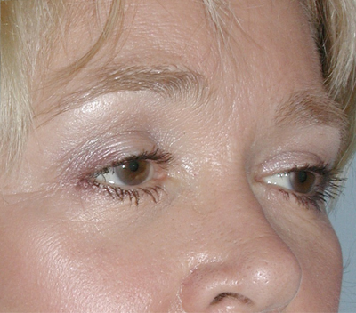 Eye Lift Before & After Image
