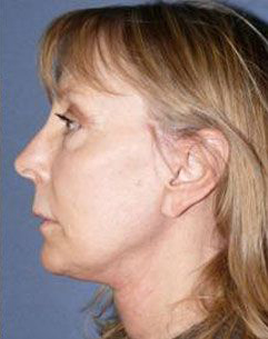 Face Lift Before & After Image