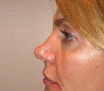 Non-Invasive Before & After Image