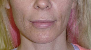 Non-Invasive Before & After Image