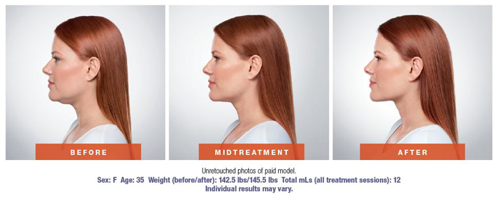 kybella before and after